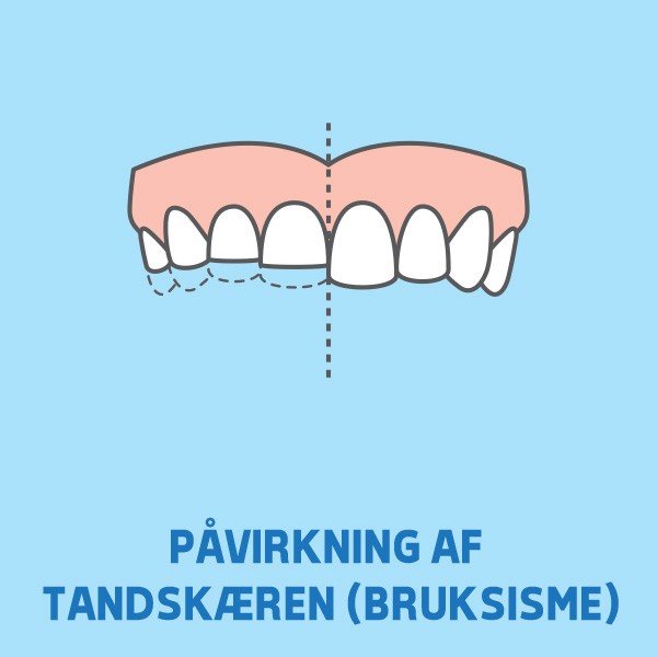 bruksisme-tandskæren-tandpres